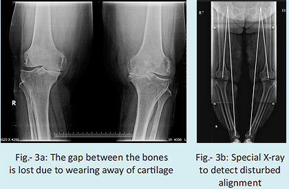 How does your doctor come to know that you need knee replacement?